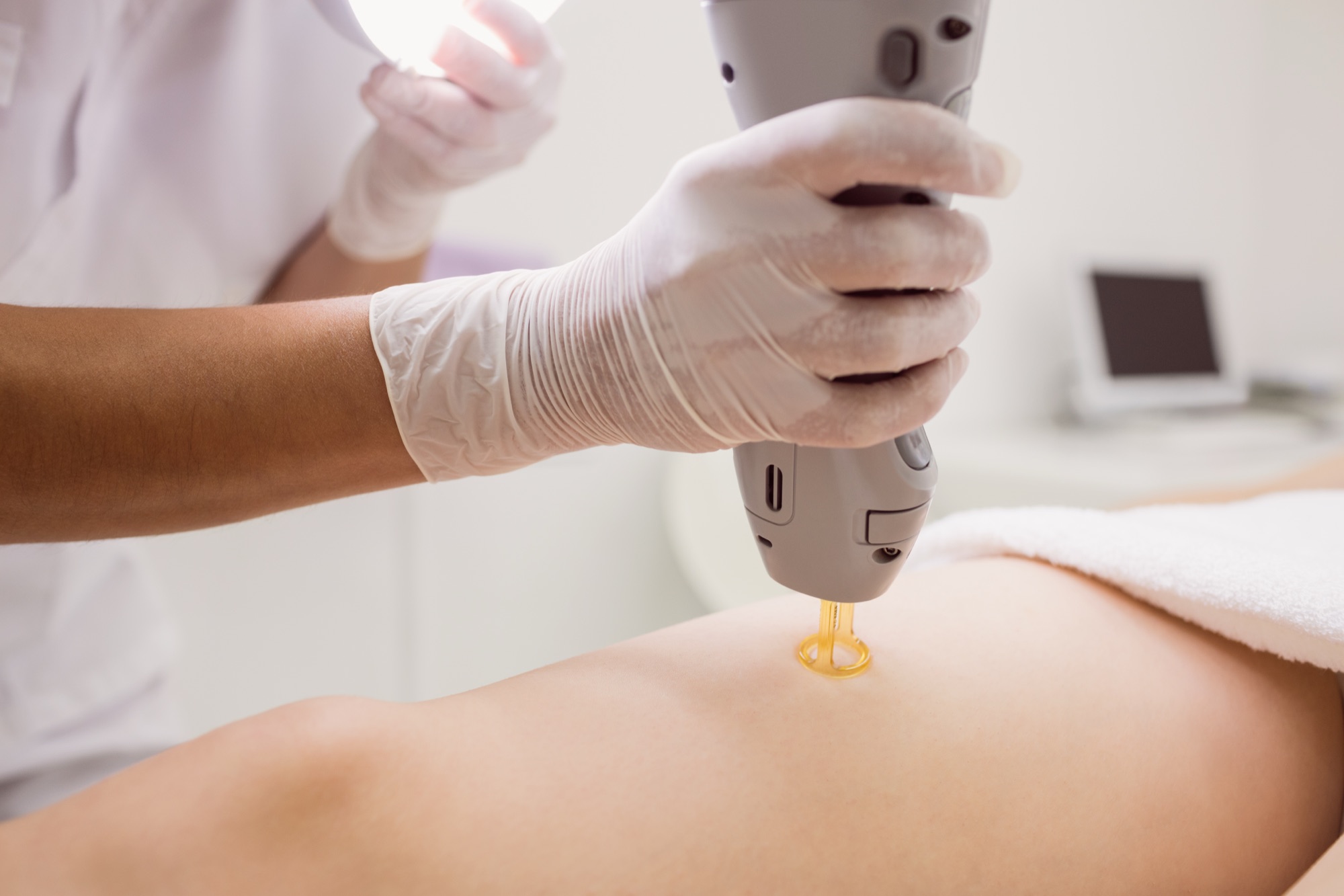 Depilação a laser definitiva - Procedimento em clínica